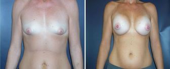 Breast-Augmentation-0069