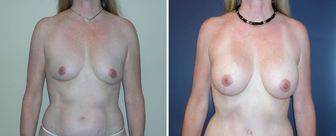 Breast-Augmentation-0072