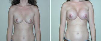 Breast-Augmentation-0073