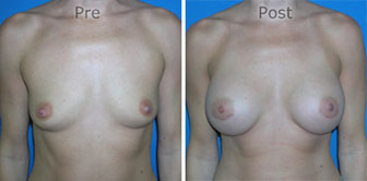 Breast-Augmentation_0033