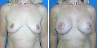 Breast-Augmentation_0043