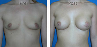 Breast-Augmentation_0047