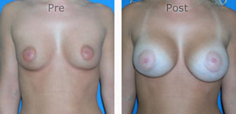 Breast-Augmentation_0051