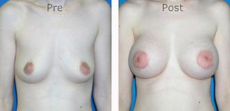 Breast-Augmentation_0054