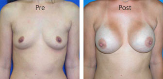 Breast-Augmentation_0057