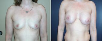 Breast_augmentation-0074