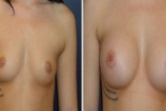 Breast-Augmentation-0059