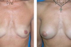 Breast-Augmentation_0039