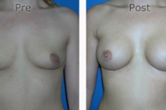 Breast-Augmentation_0047