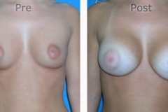 Breast-Augmentation_0051