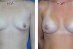 Breast-Augmentation_0053