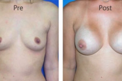 Breast-Augmentation_0057