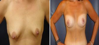 Breast-Implant_0002