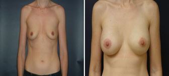 Breast-Implant_0003