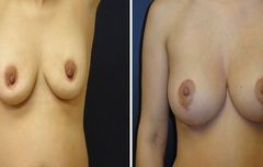 Breast-Implant_0001