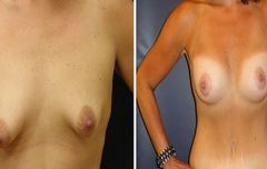 Breast-Implant_0002
