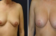 Breast-Implant_0004