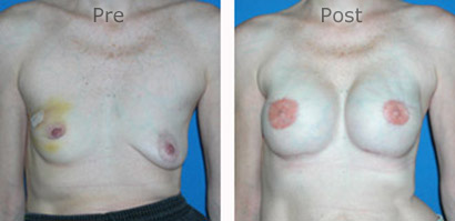 Breast-Reconstruction_0075