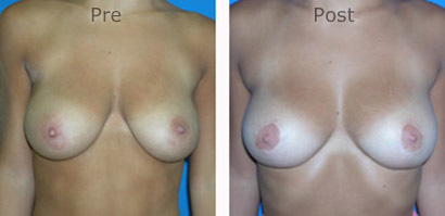 Breast-Reduction_0085