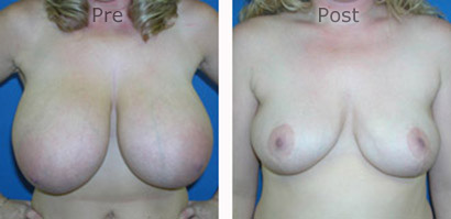 Breast-Reduction_0089