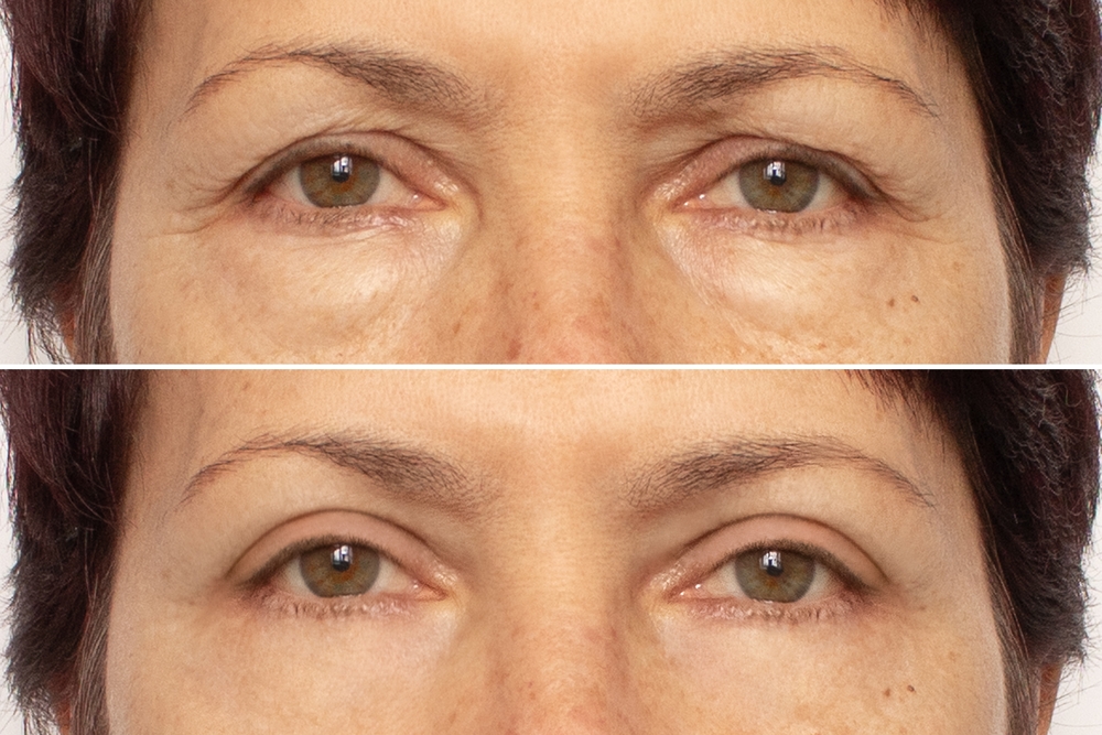 lower blepharoplasty